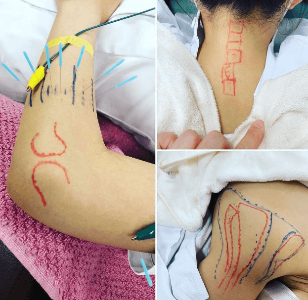Studying acupuncture