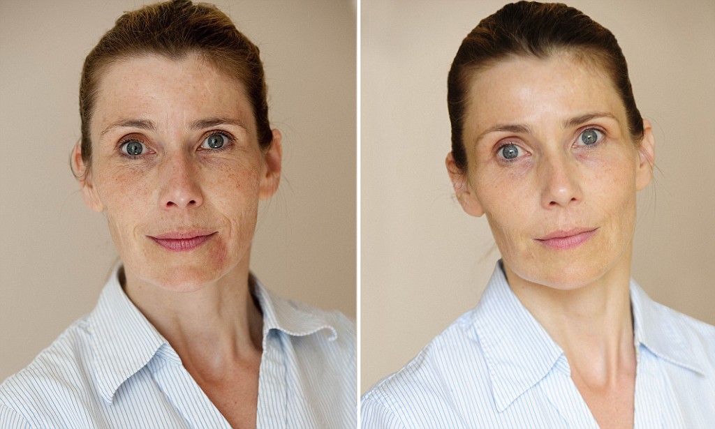 Acupuncture for Face Wrinkles in Tokyo