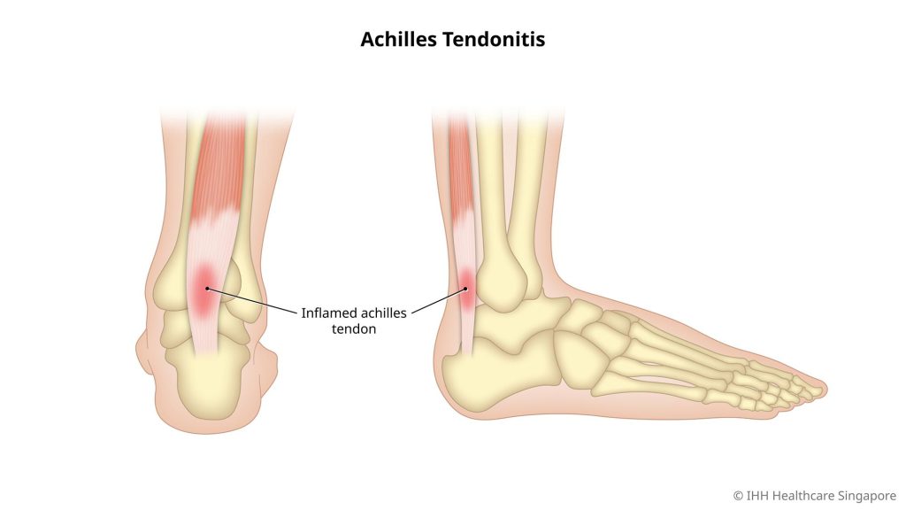 Achilles tendon pain and Acupuncture Treatment in Tokyo 2 Achilles tendon pain and Acupuncture Treatment in Tokyo