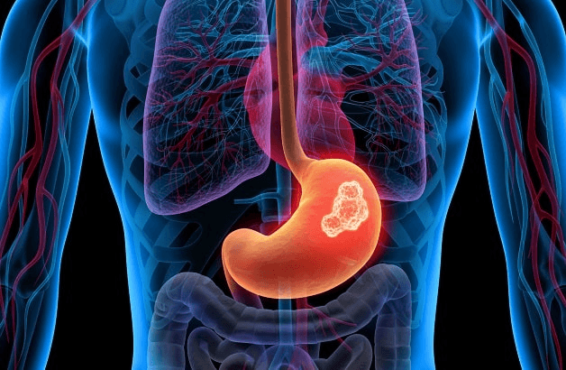 Trị dứt đầy bụng khó tiêu nhờ Đông Y