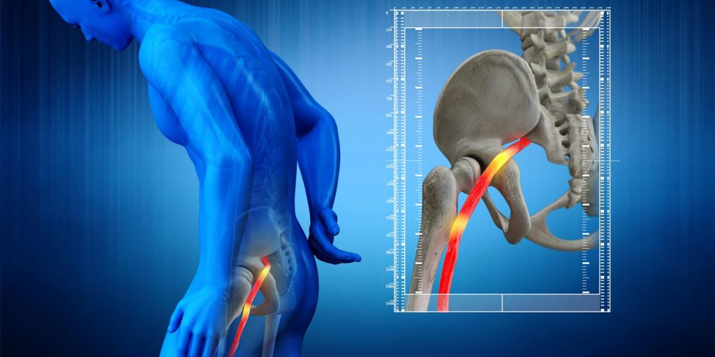 Đau thần kinh tọa - Hiểu đúng về bệnh và Những cách điều trị hiệu quả
