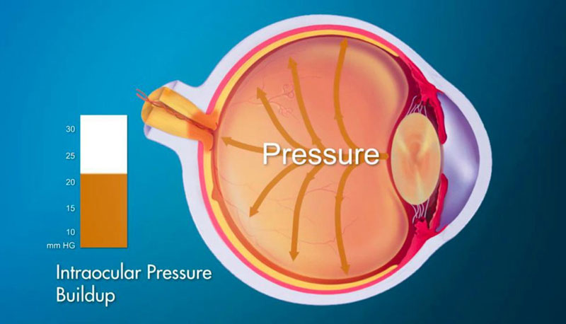 Eye Pressure & Acupuncture Treatment in Tokyo