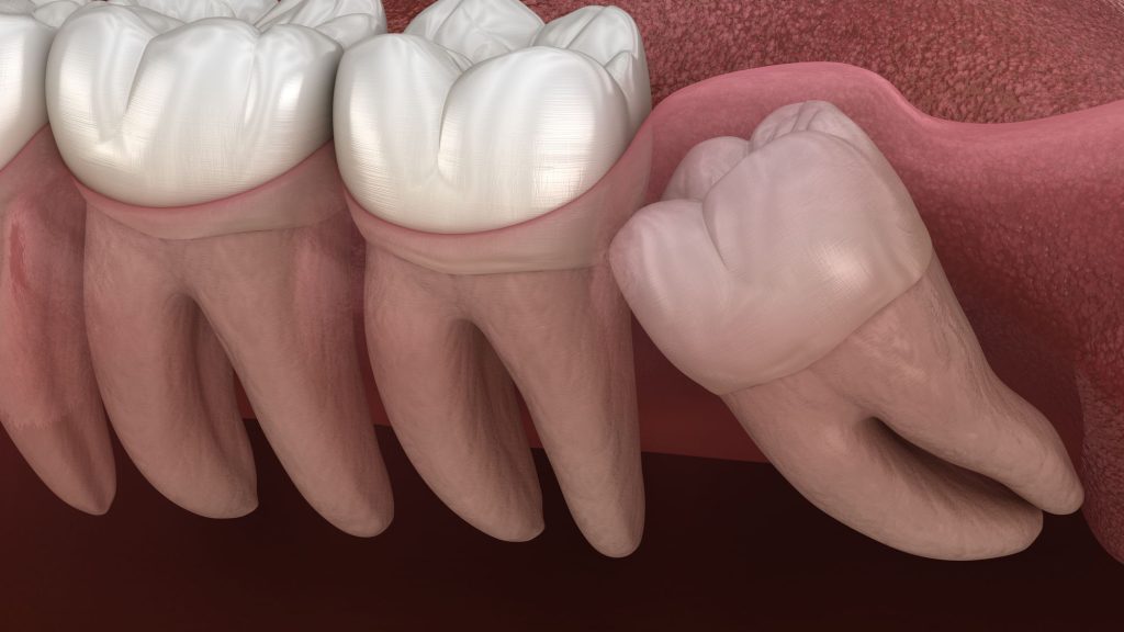 Wisdom Tooth Pain & Acupuncture Treatment in Tokyo 1 Wisdom Tooth Pain & Acupuncture Treatment in Tokyo