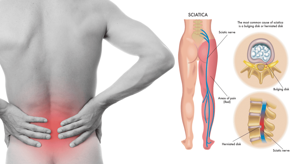 Sciatica Pain & Acupuncture Treatment in Tokyo 1 Sciatica Pain & Acupuncture Treatment in Tokyo