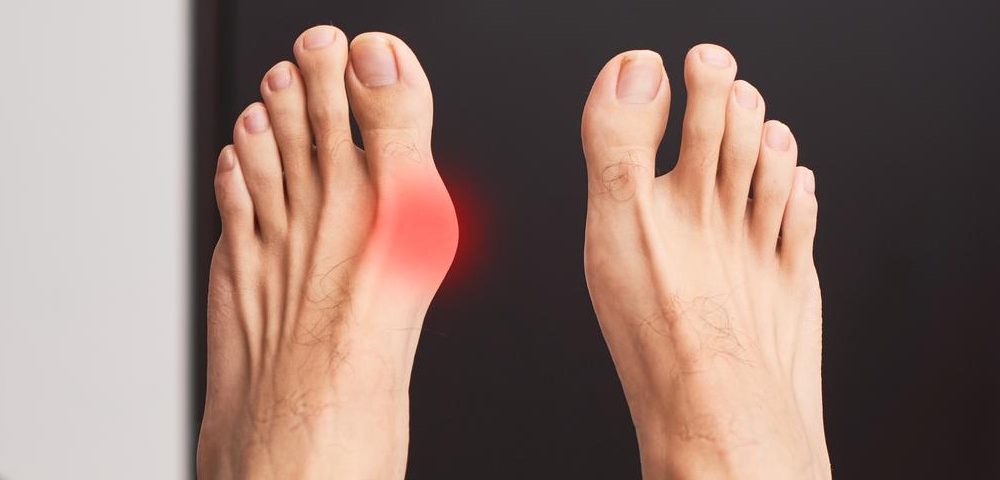 Bunion and Arch Pain: Acupuncture Treatment in Tokyo