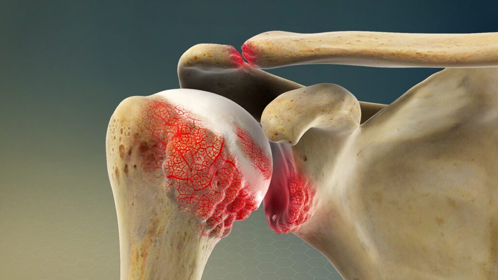Shoulder Arthritis & Acupuncture Treatment in Tokyo