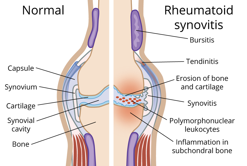 Rheumatoid Arthritis and Acupuncture Treatment in Tokyo: A Comprehensive Guide