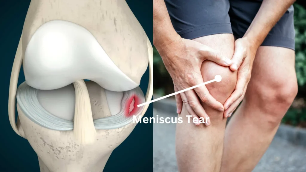 Meniscus Tear & Acupuncture Treatment in Tokyo