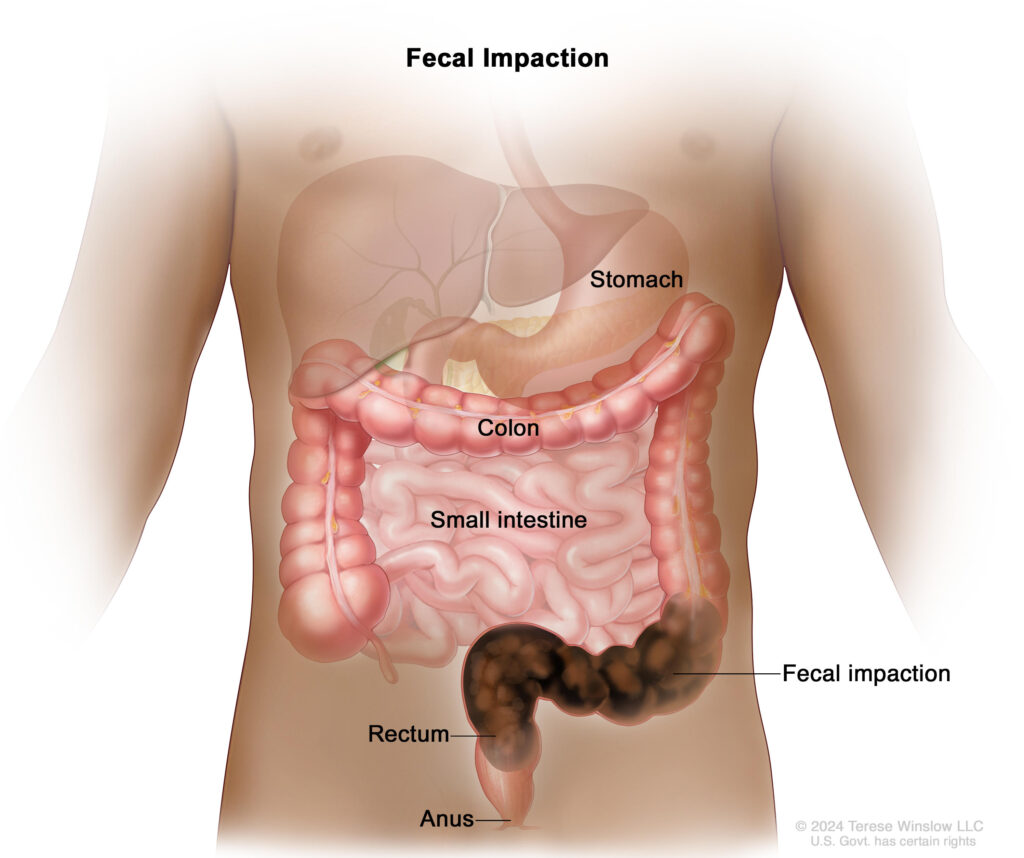 Acupuncture for Constipation in Tokyo: A Comprehensive Guide to Natural Relief