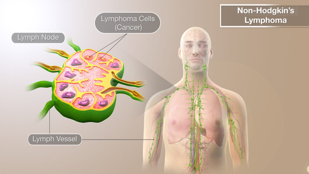 Non-Hodgkin's Lymphoma & Acupuncture Treatment in Tokyo