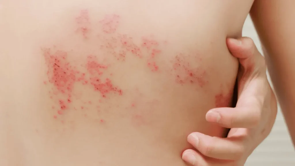 Shingles and Acupuncture: A Comprehensive Guide to Understanding and Treatment