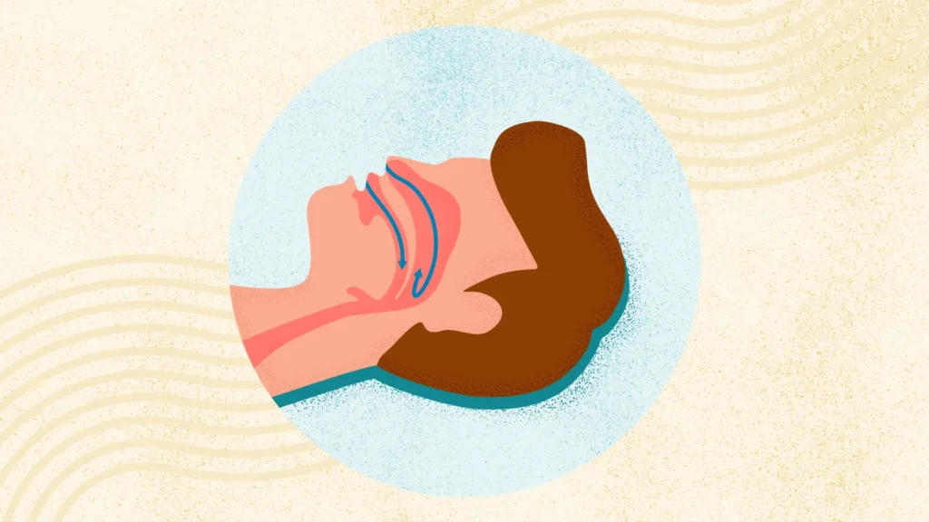 Acupuncture for Sleep Apnea: A Comprehensive Guide to a Natural Treatment Option in Tokyo