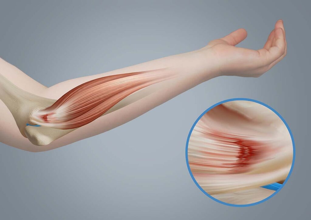 Forearm Pain & Acupuncture Treatment in Tokyo