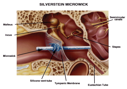 Meniere’s Disease & Acupuncture Treatment in Tokyo