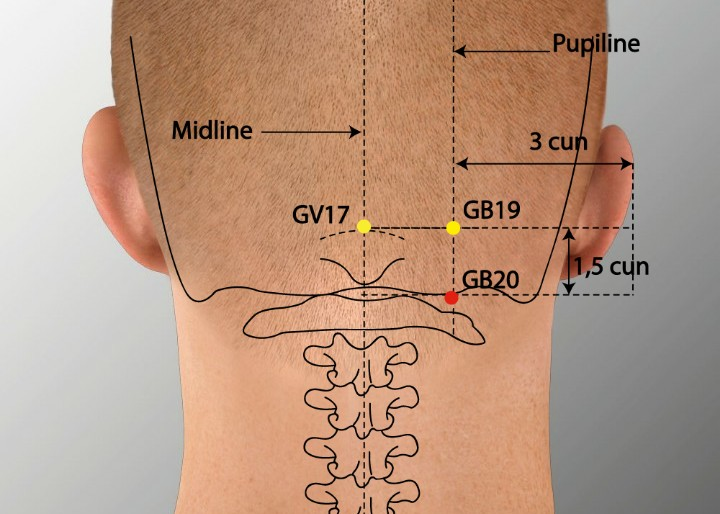 Meniere’s Disease & Acupuncture Treatment in Tokyo