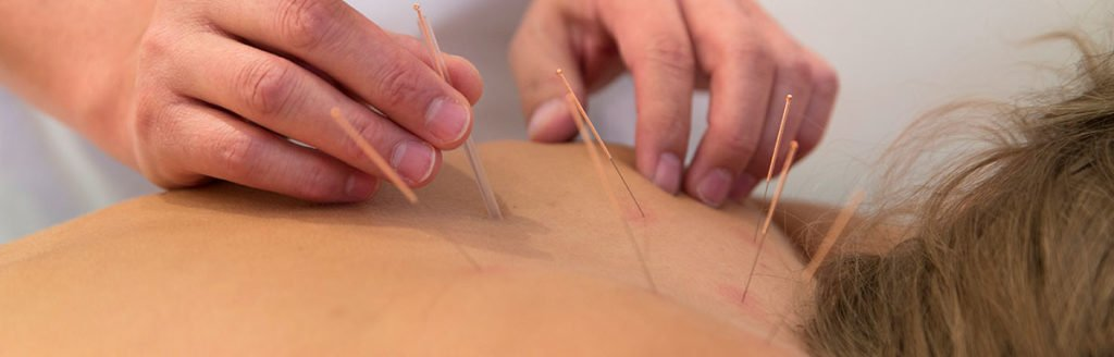 Acupuncture for Chronic Fatigue Syndrome: A Comprehensive Guide