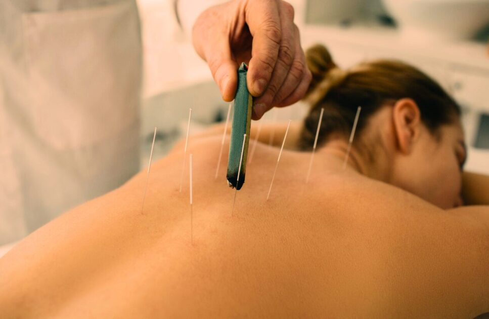 Acupuncture for Chronic Fatigue Syndrome: A Comprehensive Guide