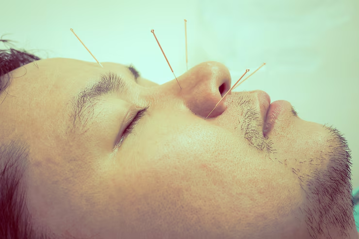 Nasal Congestion and Acupuncture Treatment in Tokyo