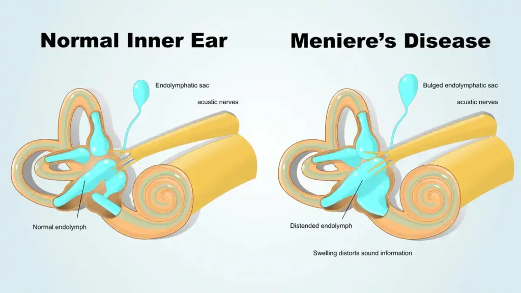 Meniere’s Disease & Acupuncture Treatment in Tokyo