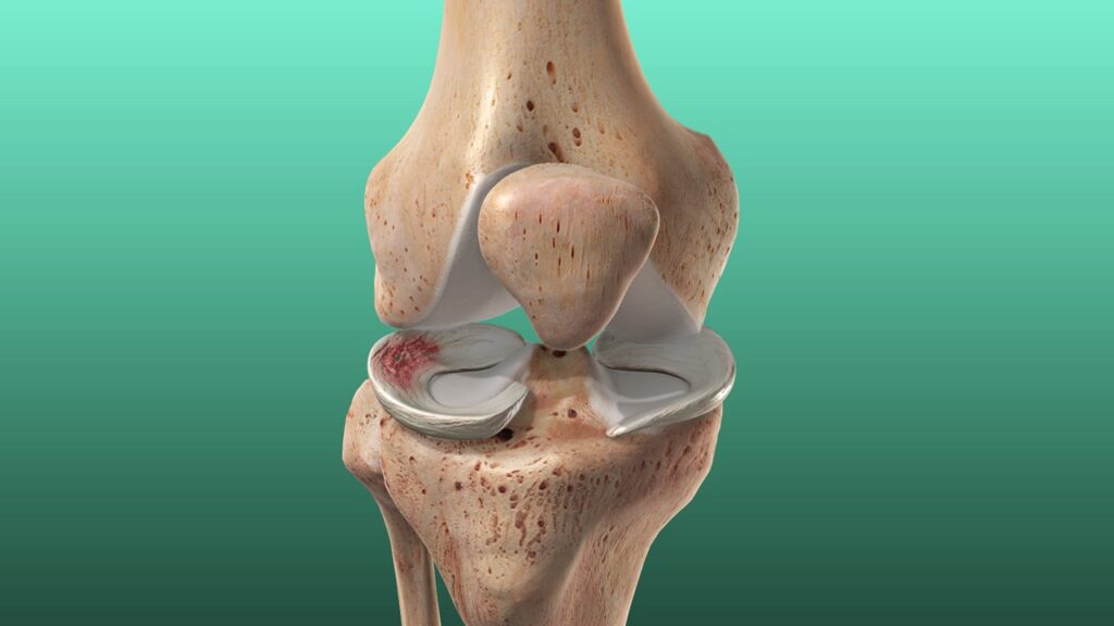 Lateral Meniscus Tears & Acupuncture Treatment in Tokyo