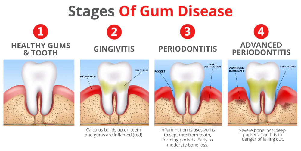 Periodontal Disease and Acupuncture Treatment