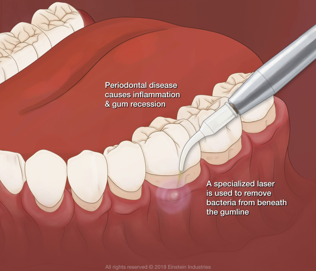 Periodontal Disease and Acupuncture Treatment