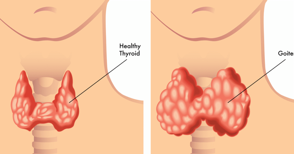 Thyroid Disease and Acupuncture Treatment in Tokyo 1 Thyroid Disease and Acupuncture Treatment in Tokyo