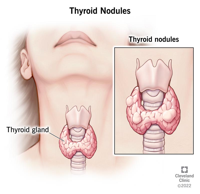 Thyroid Disease and Acupuncture Treatment in Tokyo 3 Thyroid Disease and Acupuncture Treatment in Tokyo
