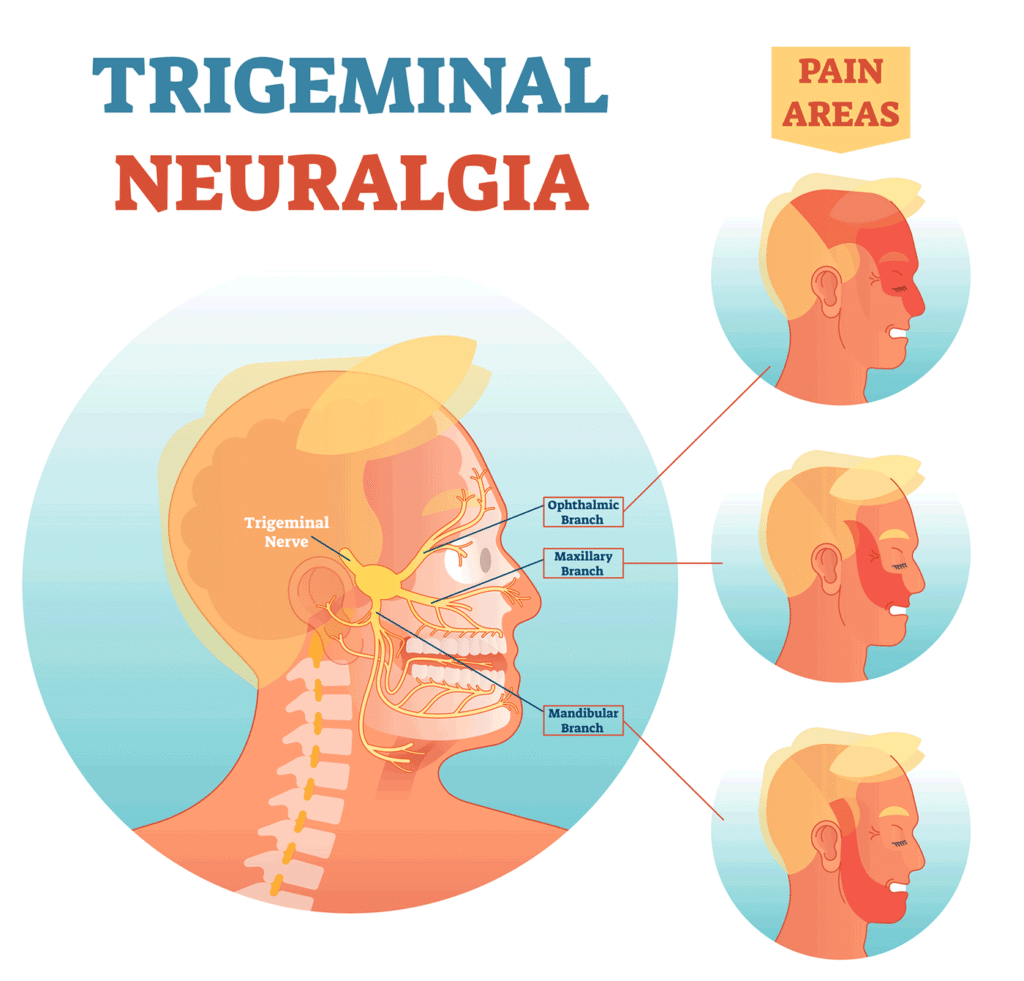 Trigeminal Neuralgia and Acupuncture: A Comprehensive Guide
